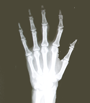Røntgenbilde av ei hånd