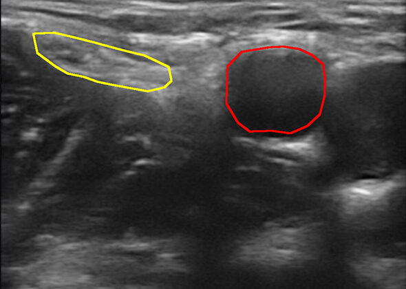 The femoral nerve (yellow) and femoral artery (red).