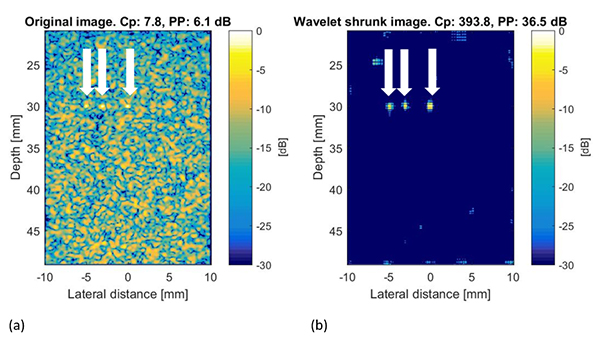 Simulated ultrasound imagery of microcalfications in human tissue.