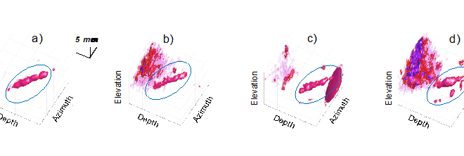 3D coronary ultrasound images at different time points of the cardiac cycle using a manual filter based on eigenvectors.