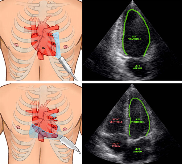 Illustrations of heart and ultrasound image of heart.