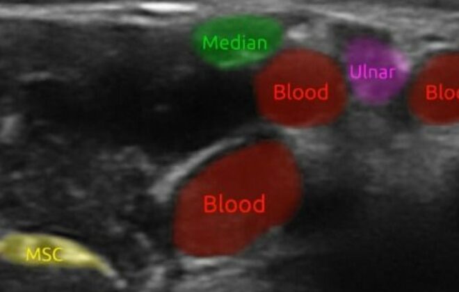 Ultrasound image with blood veins and nerves marked up.