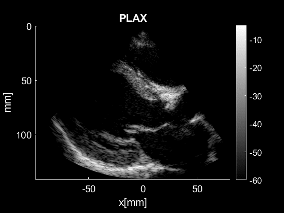 Animated gif of ultrasound image of the heart
