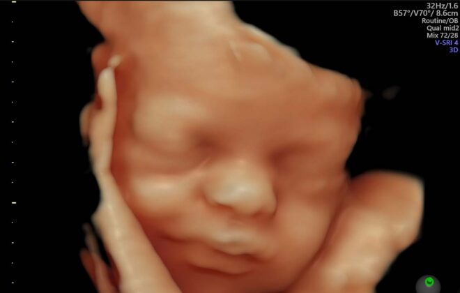 3D colour ultrasound image of baby in the womb