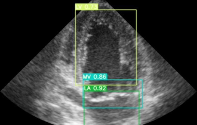 Ultrasound image of the heart.