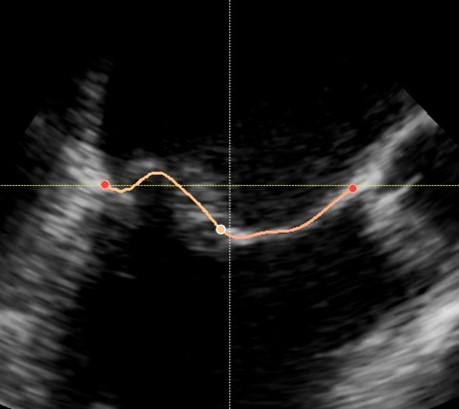 Ultrasound image tracing the mitral valve in the heart.