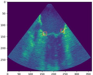 Ultrasound image of heart valve.