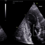 Collage of three ultrasound images of the heart.