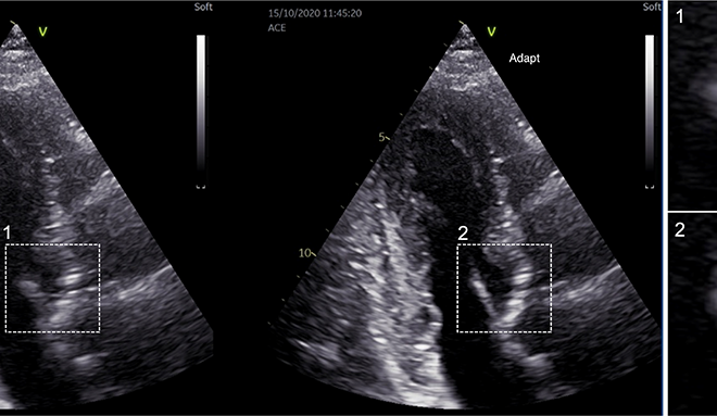 Collage of three ultrasound images of the heart.