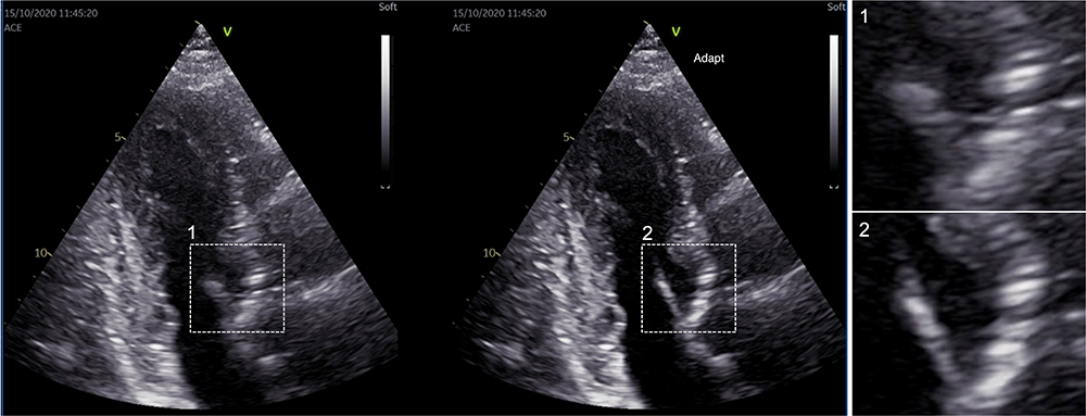 Collage of three ultrasound images of the heart.