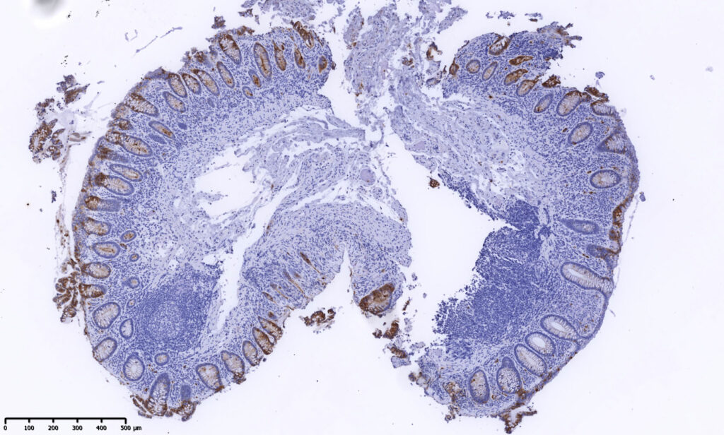 Microscopic image of tissue sample of the colon in a patient with microscopic colitis.