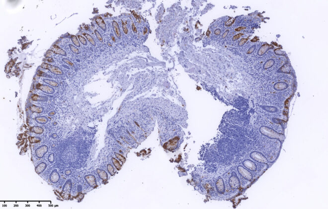 Microscopic image of tissue sample of the colon in a patient with microscopic colitis.
