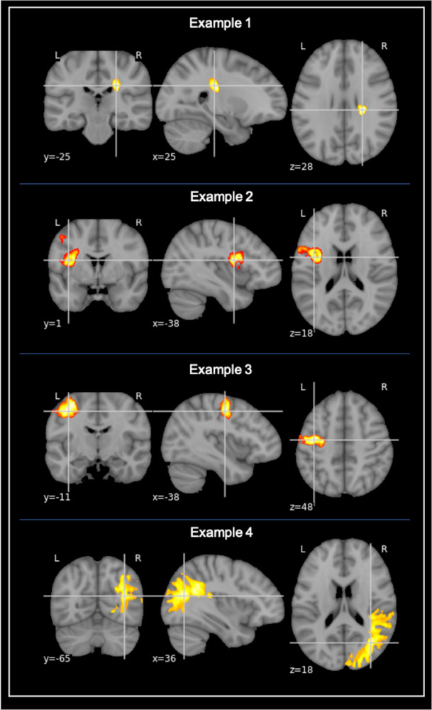 Bilde av hjerne fra CT-skanner